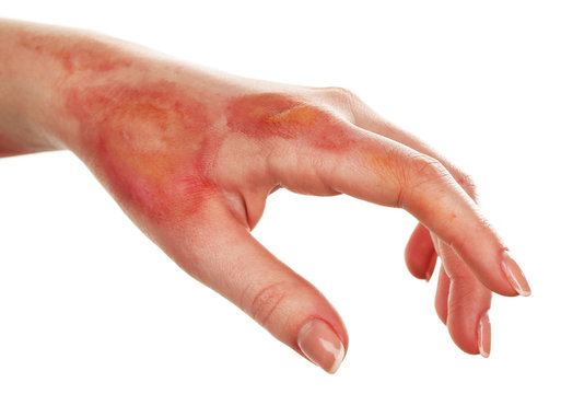 Texas Burn Injury Attorney